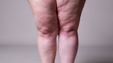 beslenme ve diyet uzmani yurttadur lipodemli bireylerde anti inflamatuar diyet yasam kalitesini artiriyor 1OgWCsah.jpg